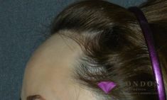 Hair Transplant - Photo before - Mr. Christopher Inglefield BSc, MBBS, FRCS(Plast)
