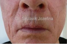 Lip Lift - Photo before - Dr. med. Jozefina Skulavik