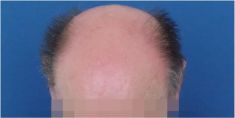 Hair Transplant - Photo before - MUDr. Jozef Hedera