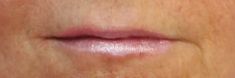 Dermal fillers - Photo before - MUDr. Jiřina Šilhánková