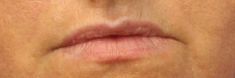 Dermal fillers - Photo before - MUDr. Jiřina Šilhánková