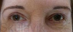 Eyelid surgery (Blepharoplasty) - Photo before - Dr. med. Jozefina Skulavik