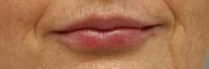Dermal fillers - Photo before - MUDr. Jiřina Šilhánková