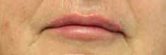 Dermal fillers - Photo before - MUDr. Jiřina Šilhánková