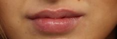 Dermal fillers - Photo before - MUDr. Jiřina Šilhánková
