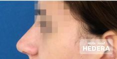 Rhinoplasty (Nose Job) - Photo before - Concept Clinic