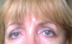 Eyelid surgery (Blepharoplasty) - Photo before - PRIMED Clinic