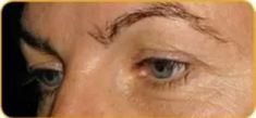 Ultherapy - Photo before - Eveclinic Bratislava
