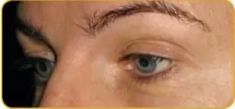 Ultherapy - Photo before - Eveclinic Bratislava