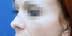 Rhinoplasty (Nose Job) - Photo before - Concept Clinic
