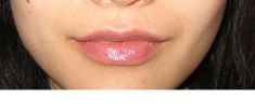 Dermal fillers - 1mL of dermal filler was carefully used to enhance this lip