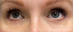 Eye Bags Treatment - Photo before