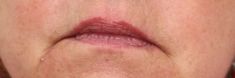 Dermal fillers - Photo before - MUDr. Jiřina Šilhánková