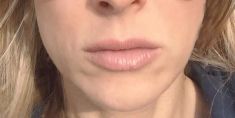 Botulinum toxin - Wrinkle Removal - Photo before - Concept Clinic