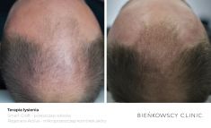 Hair Transplant - Photo before - Dr n. med. Marcin Bieńkowski