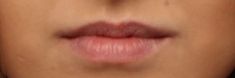 Dermal fillers - Photo before - MUDr. Jiřina Šilhánková