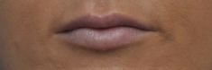 Dermal fillers - Photo before - MUDr. Jiřina Šilhánková