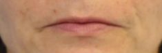 Dermal fillers - Photo before - MUDr. Jiřina Šilhánková
