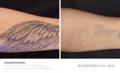 Tattoo removal - Photo before - Dr Ilona Wnuk-Bieńkowska