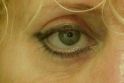 Eyelid surgery (Blepharoplasty) - Photo before - Ústav estetické medicíny Praha - Emauzy