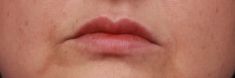 Dermal fillers - Photo before - MUDr. Jiřina Šilhánková