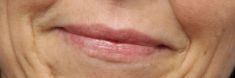 Dermal fillers - Photo before - MUDr. Jiřina Šilhánková
