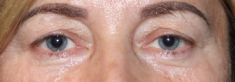 Eyelid surgery (Blepharoplasty) - Photo before - Dr n. med. Lubomir Lembas