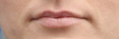 Dermal fillers - Photo before - MUDr. Jiřina Šilhánková