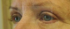 Eyelid surgery (Blepharoplasty) - Photo before
