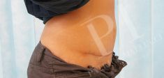 Abdominoplasty (Tummy Tucks) - Photo before - Dr. Patrick Mallucci