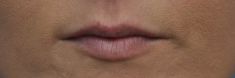Dermal fillers - Photo before - MUDr. Jiřina Šilhánková