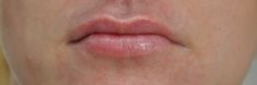 Dermal fillers - Photo before - MUDr. Jiřina Šilhánková