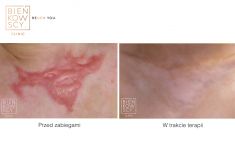 Laser Scar Treatment - Photo before - Dr Ilona Wnuk-Bieńkowska