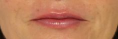 Dermal fillers - Photo before - MUDr. Jiřina Šilhánková