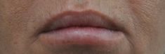 Dermal fillers - Photo before - MUDr. Jiřina Šilhánková