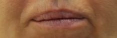 Dermal fillers - Photo before - MUDr. Jiřina Šilhánková