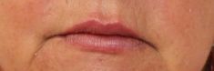 Dermal fillers - Photo before - MUDr. Jiřina Šilhánková