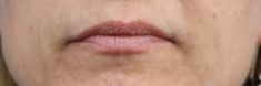 Dermal fillers - Photo before - MUDr. Jiřina Šilhánková