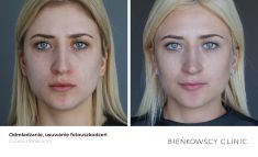 Spider veins laser removal (redness, birh marks) - Photo before - Bieńkowscy Clinic®