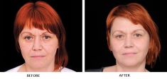 Mesotherapy (face, neck revitalization) - Photo before - Laserová dermatologická klinika ALTOS