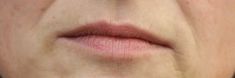 Dermal fillers - Photo before - MUDr. Jiřina Šilhánková