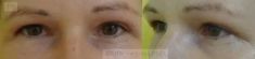 Eyelid surgery (Blepharoplasty) - Photo before - MUDr. Jozef Fedeleš PhD.