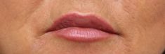 Dermal fillers - Photo before - MUDr. Jiřina Šilhánková