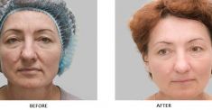 Mesotherapy (face, neck revitalization) - Photo before - Laserová dermatologická klinika ALTOS