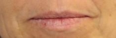 Dermal fillers - Photo before - MUDr. Jiřina Šilhánková