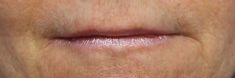 Dermal fillers - Photo before - MUDr. Jiřina Šilhánková