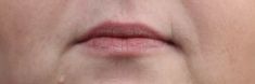 Dermal fillers - Photo before - MUDr. Jiřina Šilhánková