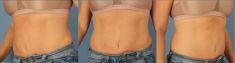 CoolSculpting - Photo before