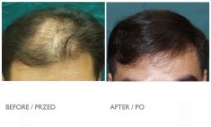 Hair Transplant - Photo before - Mandala Beauty Clinic