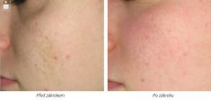 Age Spots Treatment - Photo before - Laserová dermatologická klinika ALTOS